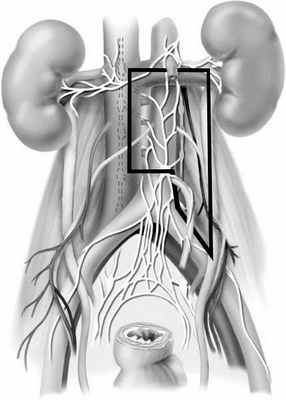 пути метастазирования рака яичка