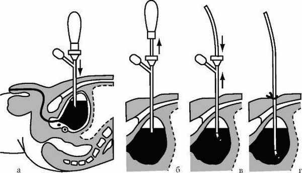  Схема этапов троакарной эпицистостомии (из