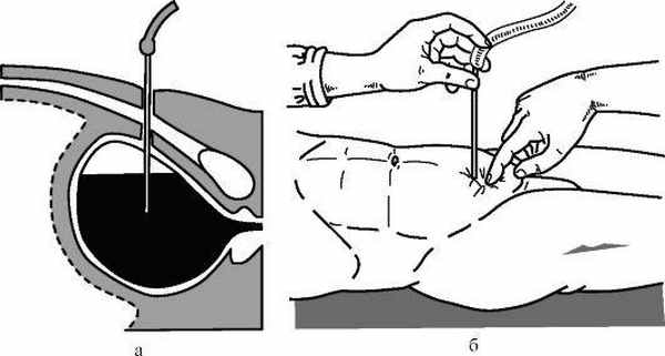  Надлобковая капиллярная пункция мочевого пузыря (из