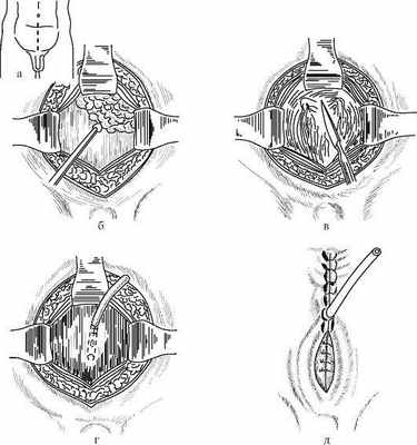  Этапы цистостомии. (из