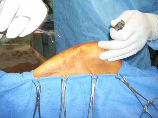 подготовка поля операции