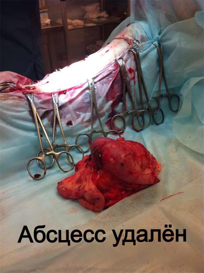 Абсцесс удален