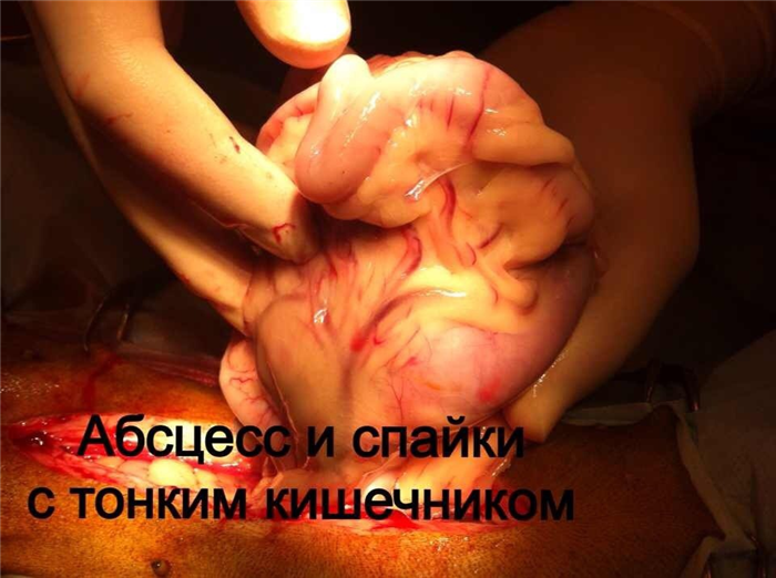 абсцесс брюшной полости и его спайки с кишечником фото 2