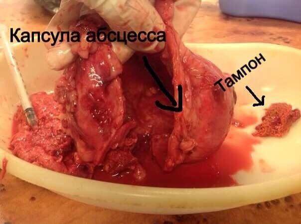 Капсула абсцесса