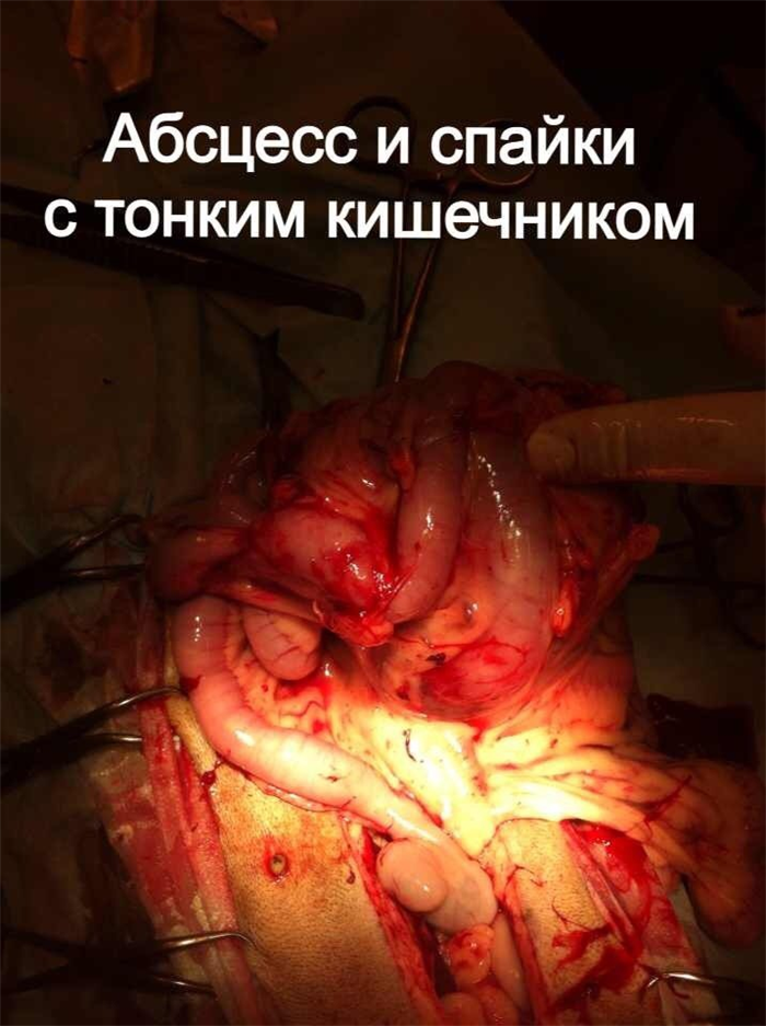 абсцесс брюшной полости и его спайки с кишечником