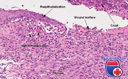 раневой канал