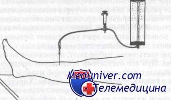 туннельный синдром голени