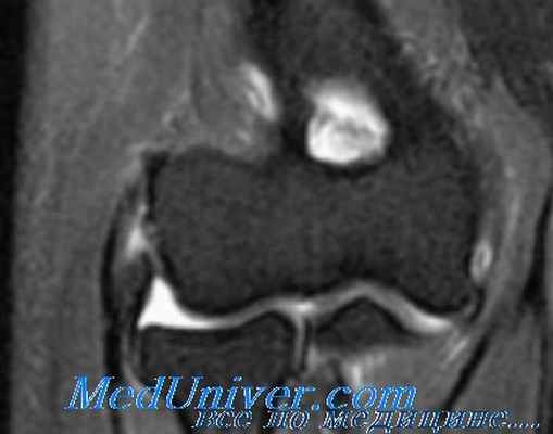эпикондилит плеча
