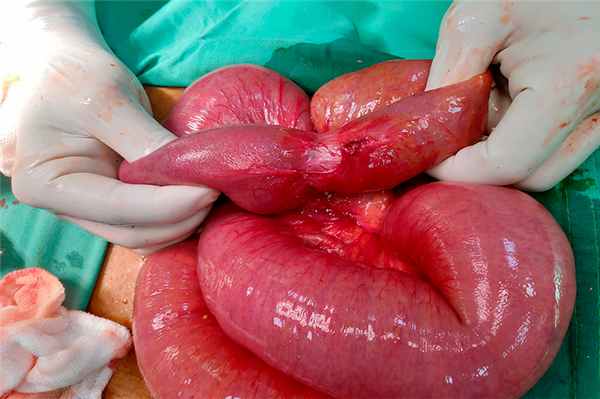 Кишечная непроходимость