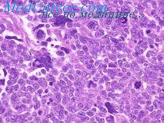 опухоль вильмса