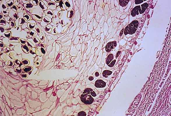 Часть взрослой особи лёгочной двуустки в просвете бронха, крупные фиолетовые пятна — созревающие яйца. Окрашенный гистологический препарат