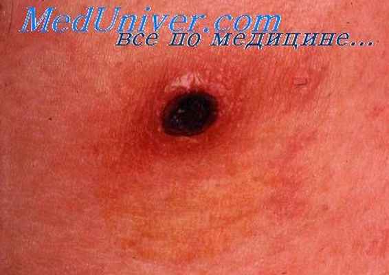 риккетсиозы