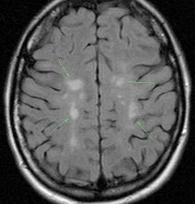 Очаги рассеянного склероза на МРТ