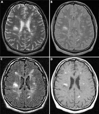 признаки РС на МРТ головного мозга