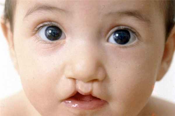 Заячья губа