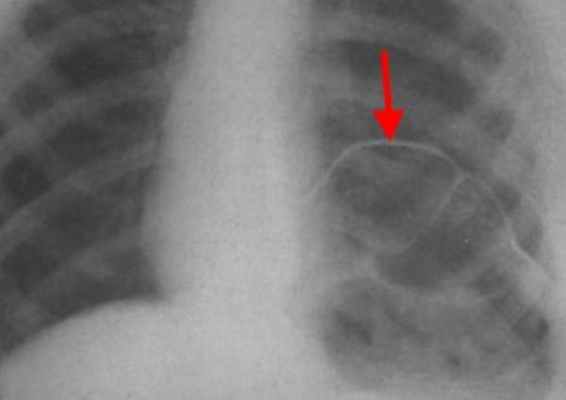 релаксация диафрагмы рентген