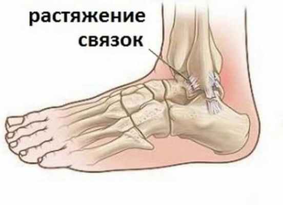 Растяжение связок голеностопного сустава: первая помощь, лечение, причины, симптомы