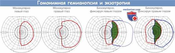 Гомонимная гемианопсия и экзотропия