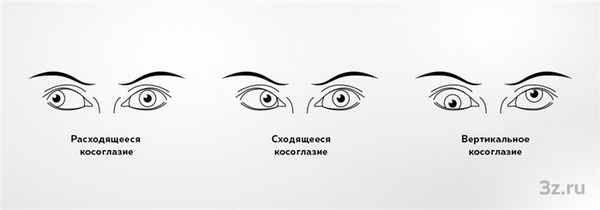 Виды косоглазия по типу отклонения