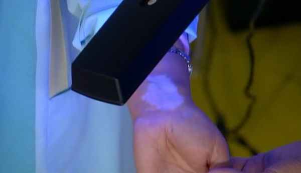 Диагностика отрубевидного лишая