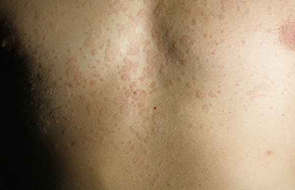 Отрубевидный (разноцветный) лишай фото