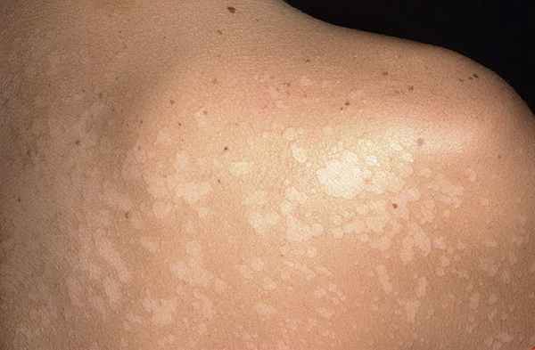 Отрубевидный лишай