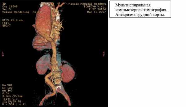 Мультиспиральная компьютерная томография Аневризма грудной аорты