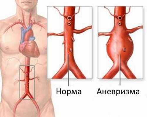 Аневризма брюшной аорты