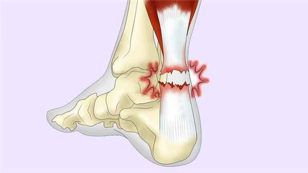 Разрыв ахиллова сухожилия