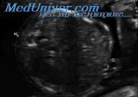 фокомелия плода