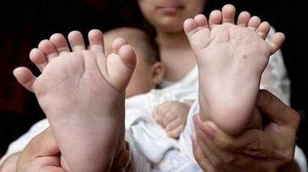 Пороки развития нижних конечностей