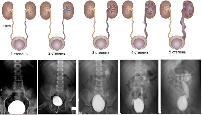 Градация пузырно-мочеточникового рефлюкса по степеням