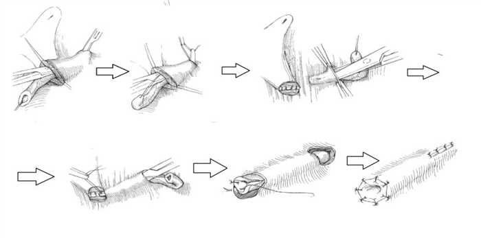 способ Политано-Леадбеттера (Politano-Leadbetter)