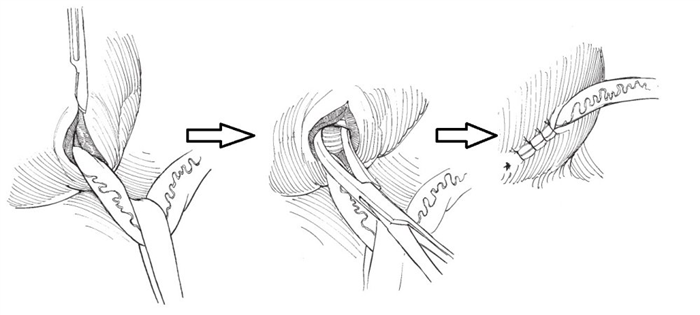 по Лич-Грегуар (Lich-Gregoir)