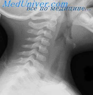 томография гортани