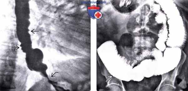 Рентгенограмма (эзофагография) при склеродермии пищевода