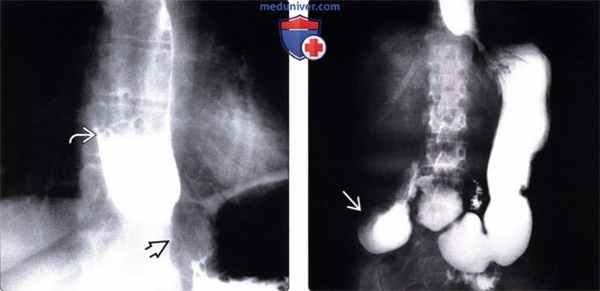 Рентгенограмма (эзофагография) при склеродермии пищевода