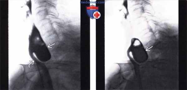 Рентгенограмма (эзофагография) при дивертикуле Ценкера