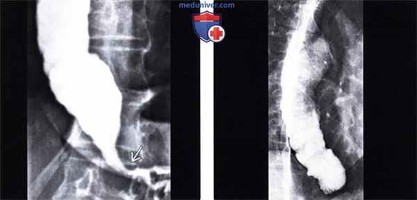 Рентгенограмма (эзофагография) при дискинезии пищевода