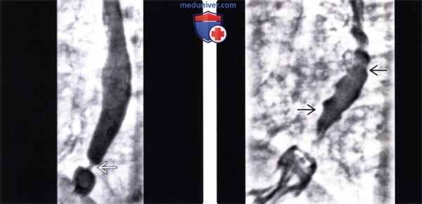 Рентгенограмма (эзофагография) при дискинезии пищевода