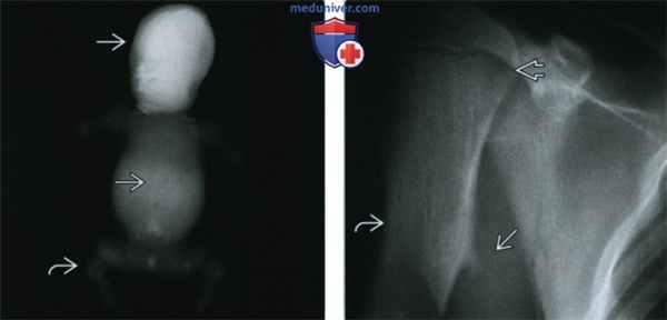 Кости при гипофосфатазии - лучевая диагностика