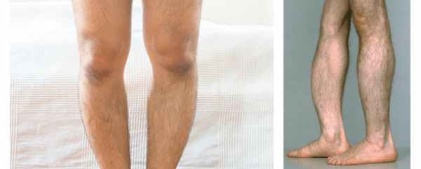 Искривление ног при гипофосфатазии у взрослых