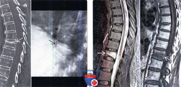 Рентгенограмма, КТ, МРТ при остеопорозе позвоночника
