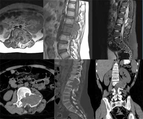киста кости позвоночника.jpg
