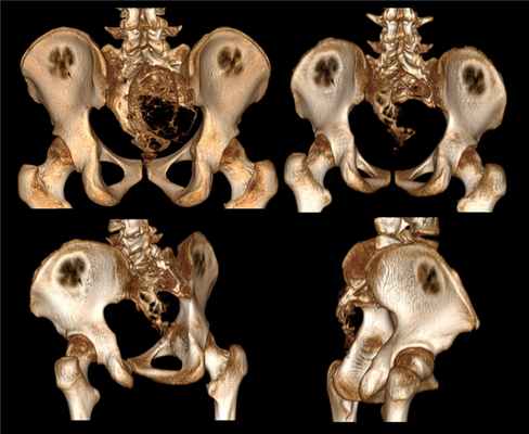 Костная киста позвоночника на МРТ