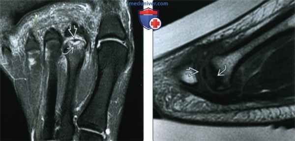 Признаки болезни Фрейберга