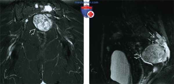 Рентгенограмма, МРТ при хордоме