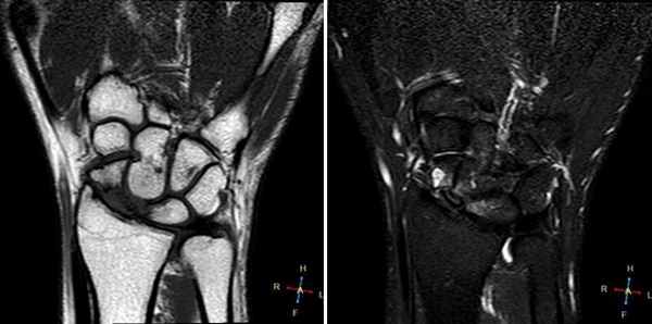 МРТ кисти: когда назначается?