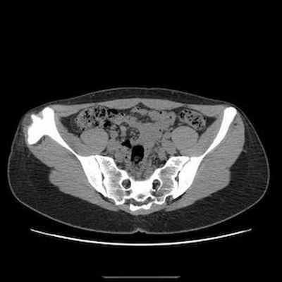 Хондросаркома на почве остеогенного экзостоза TDM Abdomen Axial tissus mous