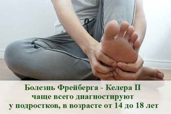 Болезнь Фрейберга - Келера II 
